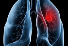 Saiba o que é adenocarcinoma pulmonar, câncer que atinge o Papa Leão